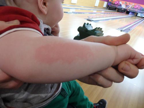 The burn on our son's arm after a split second of being in contact with the fire place.